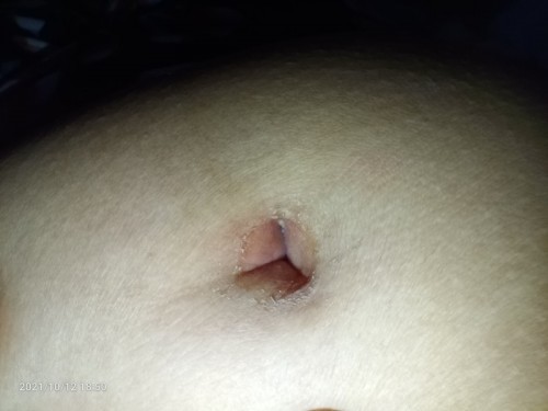 Hi there mommies, namamaga kasi ang pusod ko, may nakaranas na rin ba ng ganito sainyo? Salamat.