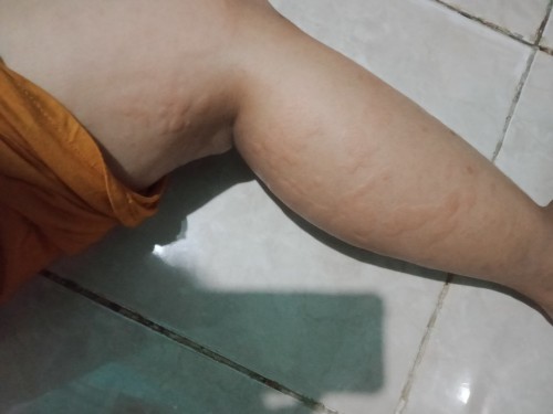 Biduran Bun info obat yg ampuh dan aman untuk busui mengatasi biduran, udah 5 bulanan blm sembuh"
