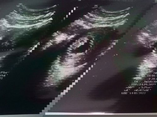 Sharing hasil USG nya bun