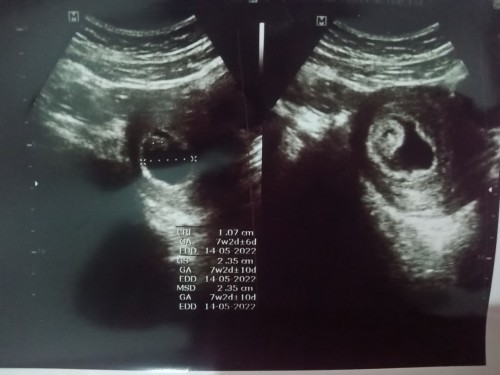 Sharing hasil USG nya bun