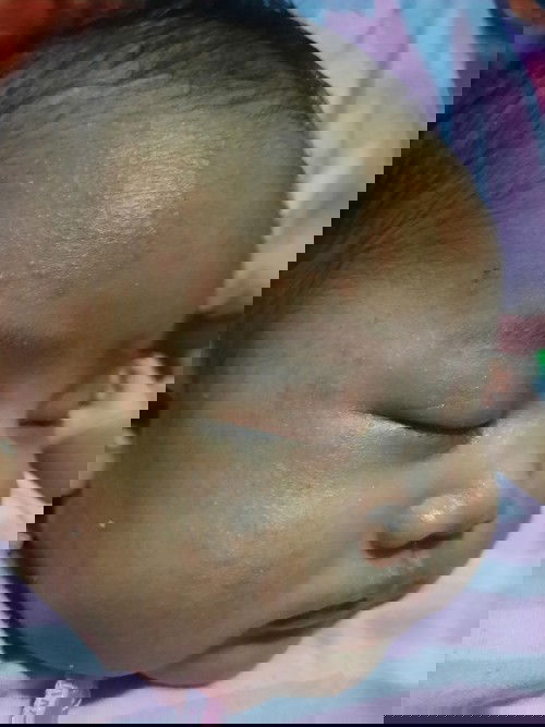 Bintik merah pada wajah bayi usia 3 minggu