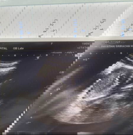 กังวลใจว่าท้องลมหรือครรภ์หยุดการเจริญเติบโตหรือเปล่า?