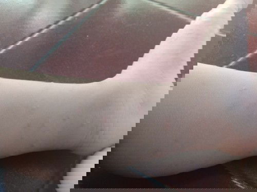 Gatal pada kulit bayi