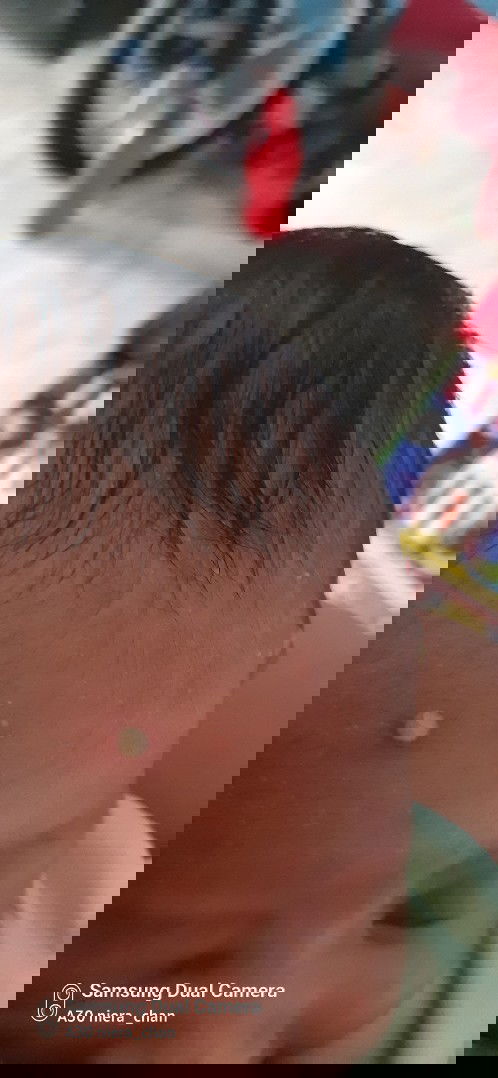 Ada yang bayi nya begini juga gak bun ?? Seperti jerawat,Harus di pakein obat apa ya ??