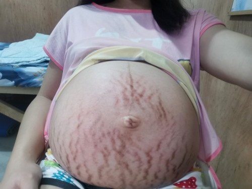 Scary Stretch Marks