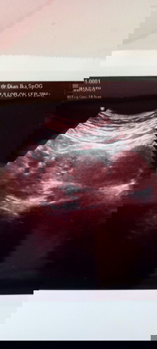 Ini hsil USG janin sy. Bisa dijelaskan apa memang sdh terlihat td kehamilan kt dokter usia 6 minggu