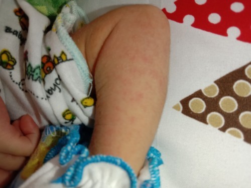 Bintik-bintik merah dan berair pada kulit bayi