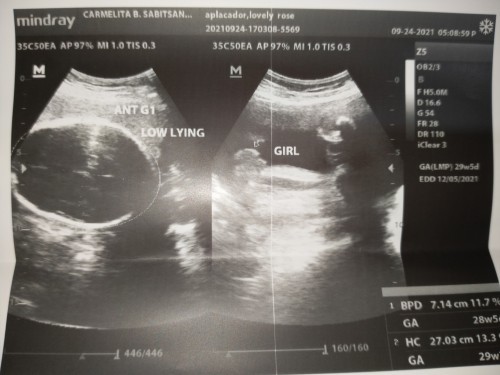 Low Lying Placenta