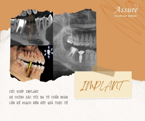 𝐂𝐀̂́𝐘 𝐆𝐇𝐄́𝐏 𝐈𝐌𝐏𝐋𝐀𝐍𝐓 - 𝐏𝐇𝐔̛𝐎̛𝐍𝐆 𝐏𝐇𝐀́𝐏 𝐏𝐇𝐔̣𝐂 𝐇𝐎̂̀𝐈 𝐑𝐀̆𝐍𝐆 𝐌𝐀̂́𝐓 𝐓𝐎̂́𝐈 𝐔̛𝐔
