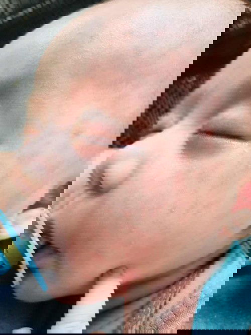 RASH AFTER 37.9 FEVER