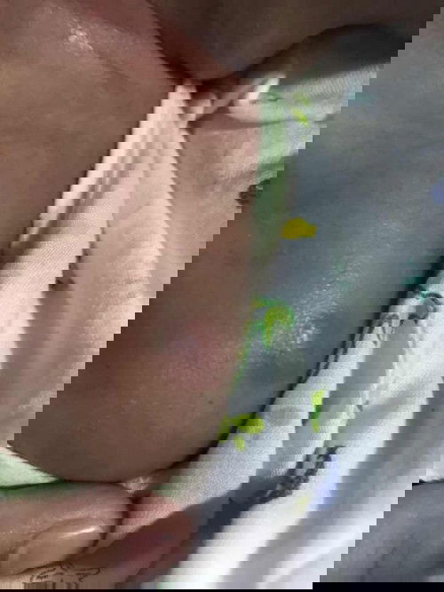 ลูกเป็นมีตุ่มใหญ่ๆตรงบริเวณหัวไหล่เกิดจากอะไรคะ