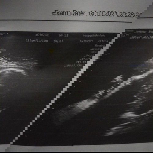 ท้อง 33สัปดาห์ ลื่นล้ม😭