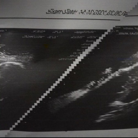 ท้อง 33สัปดาห์ ลื่นล้ม😭