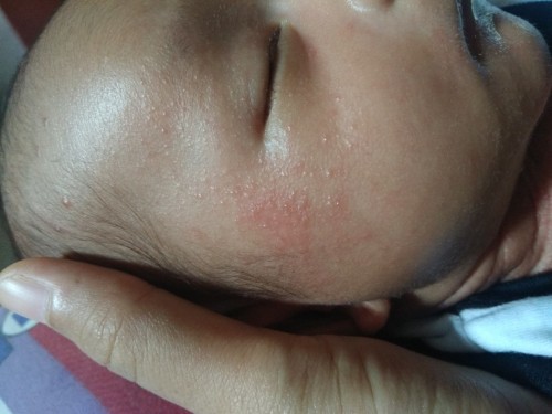 Bun maaf mau nanya.
Obat untuk bruntusan kena air susu apa y?
Usia dde baru 33 hari..