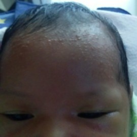 Cara ngilangin beruntusan anak aku beruntusannya ada d kepala dahi sama pipi