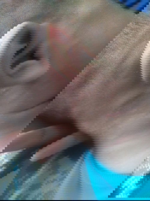 Infonya bun barangkali ada yg ngalamin sprti bayi ku.. Awal n ini ada lingkrn merah d ujung rambut