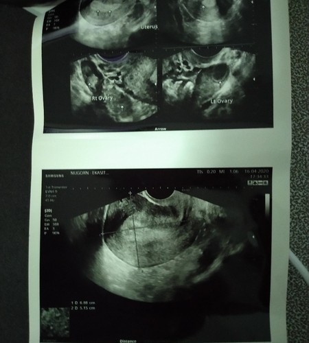 อัลตร้าซาวด์ ไม่เจอถุงตั้งครรภ์ ตกลงเราท้องไหมคะ