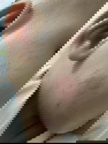 Red Patches on face and neck