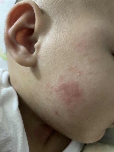 Red Patches on face and neck