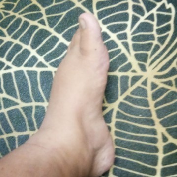38w1d edema+++