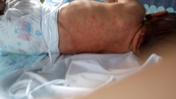 Pagnancy Rash P RASHES sa Likod Mommies, Ang rashes na to dahil kaya to sa P