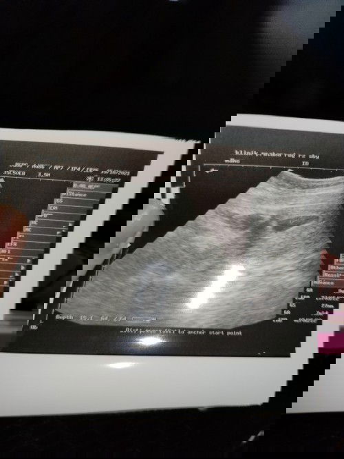 7W 3D belom terlihat janin