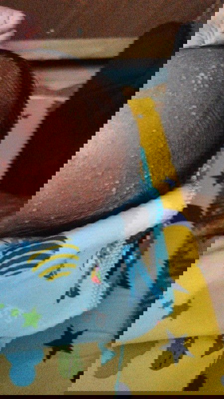 Keluar bintik nanah di dahi atau kelala bayi umur seminggu