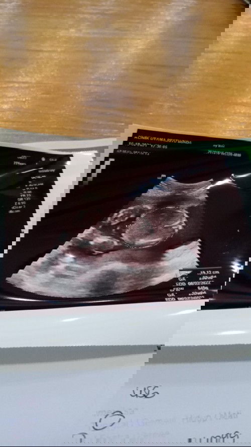 Janin bayi di dalam perutku baru 5 bulan sudah 649gram ada yang sama kah ?