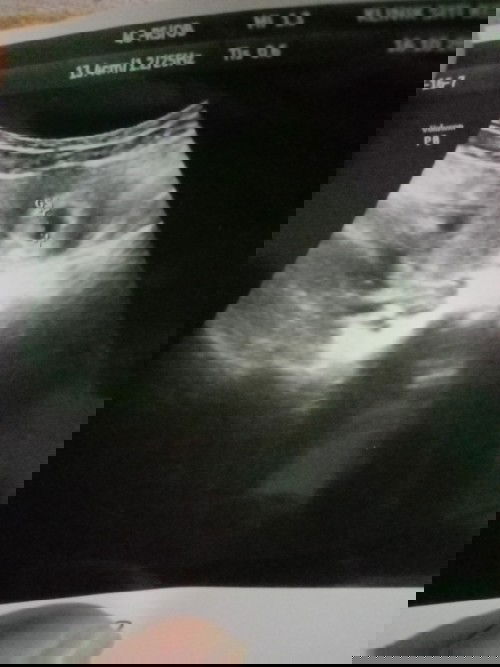 Normal ka preggy 6 minggu nampak kantung sahaja?.. risau jugak sebenarnya..4 kali dah scan