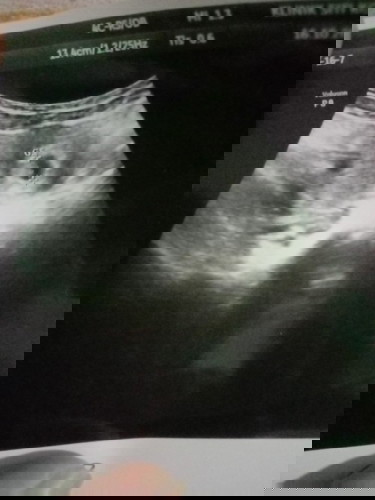 Normal ka preggy 6 minggu nampak kantung sahaja?.. risau jugak sebenarnya..4 kali dah scan