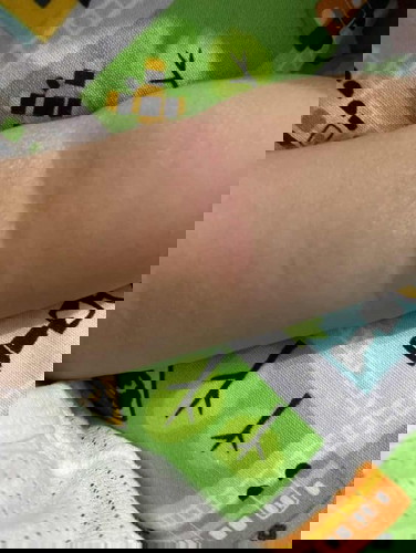 Rashes or Eczema?