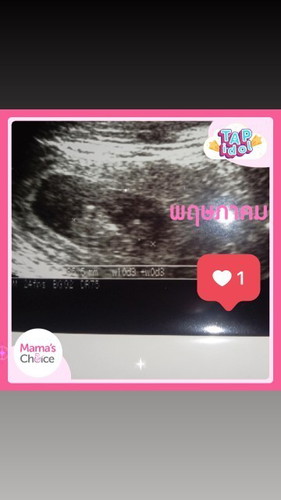 10 สัปดาห์ นัดตรวจ 17/10/64