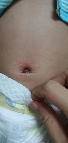 Các mom cho e hỏi bé nhà e nổi như vậy ở rốn cả tuần nay là bị gì. Có sao k