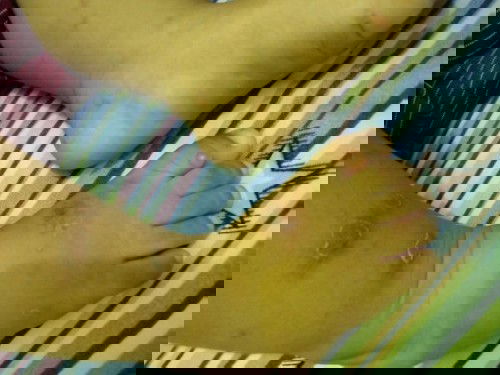 Kulit anak bentol bentol berisi air