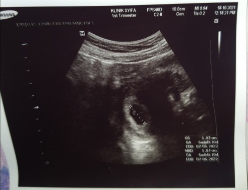 Cramp yg kuat tidak diikuti spotting @ bleeding