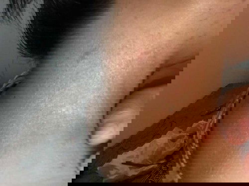 kulit seperti kebakar