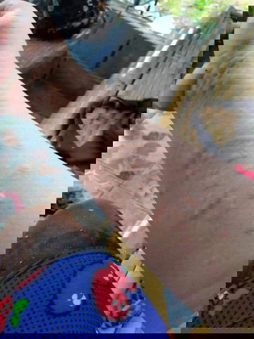 คันหลังผ่าคลอดบล็อกหลัง