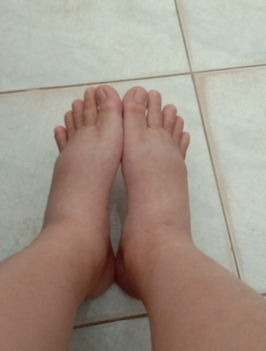 35W 2d เท้าบวม กดแล้วบุ๋ม ไม่เด้งกลับเลยค่ะ ทำไงดีคะ