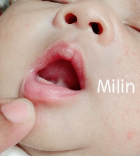 ว่ากันด้วย...พังผืดใต้ลิ้นลูก👅 อันตรายไหม รักษาอย่างไร