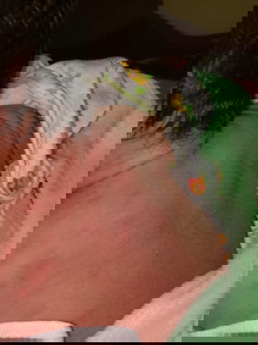 ผดผื่นแบบนี้คืออะไรค่ะ