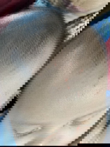 Menghilangkan luka cakar