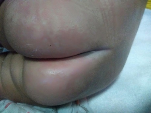 เป็นผื่นขึ้นที่ก้นคะใครมียาดีแนะนำมั้ยคะ