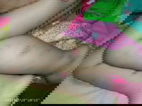 Gatal gatal pada anak