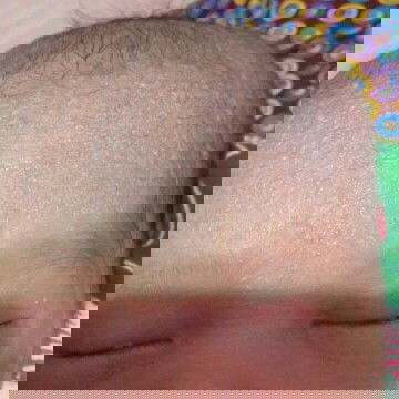 Anak sya baru lahir tapi Kepala na benjol bun,,ada yg sama ngga