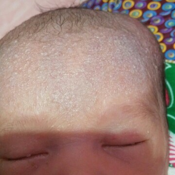 Anak sya baru lahir tapi Kepala na benjol bun,,ada yg sama ngga