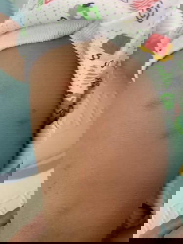 มีลูกแม่ๆคนไหนลูกแพ้ยุง แนะนำยาทาบ้างค่ะ