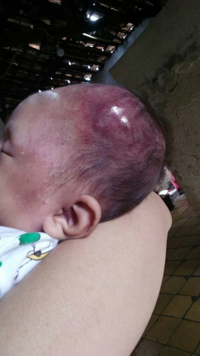 Obatnya apa yah..benjolan di kepala sejak lahir