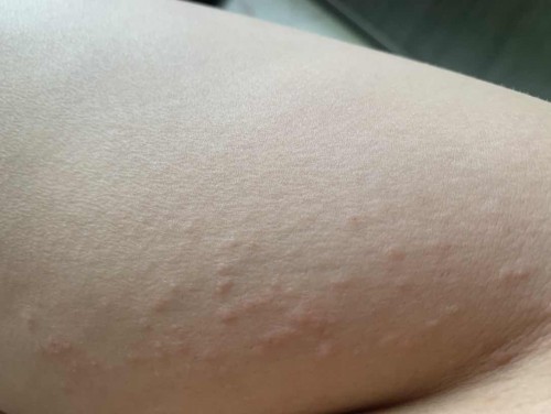 ผื่นขึ้น ท้องได้24วีค