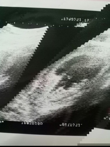 20/10/2021
วันนี้ไปหาหมอมาค่ะหมอซาวต์ดูน้องๆไม่ยอมกลับหัว33w6แล้วแม่คนไหนเจอแบบนี้ไหมค่ะแล้วมี