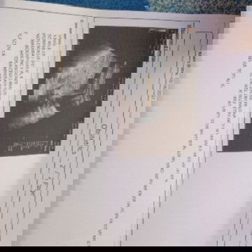 3rd pregnancy placenta previa totalis